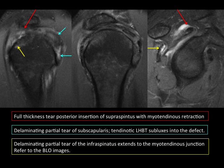 Figure 5 for case tendon of rotator cuff ( RID1948 )